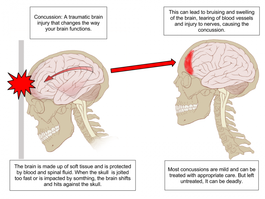 Anatomy of a concussed brain